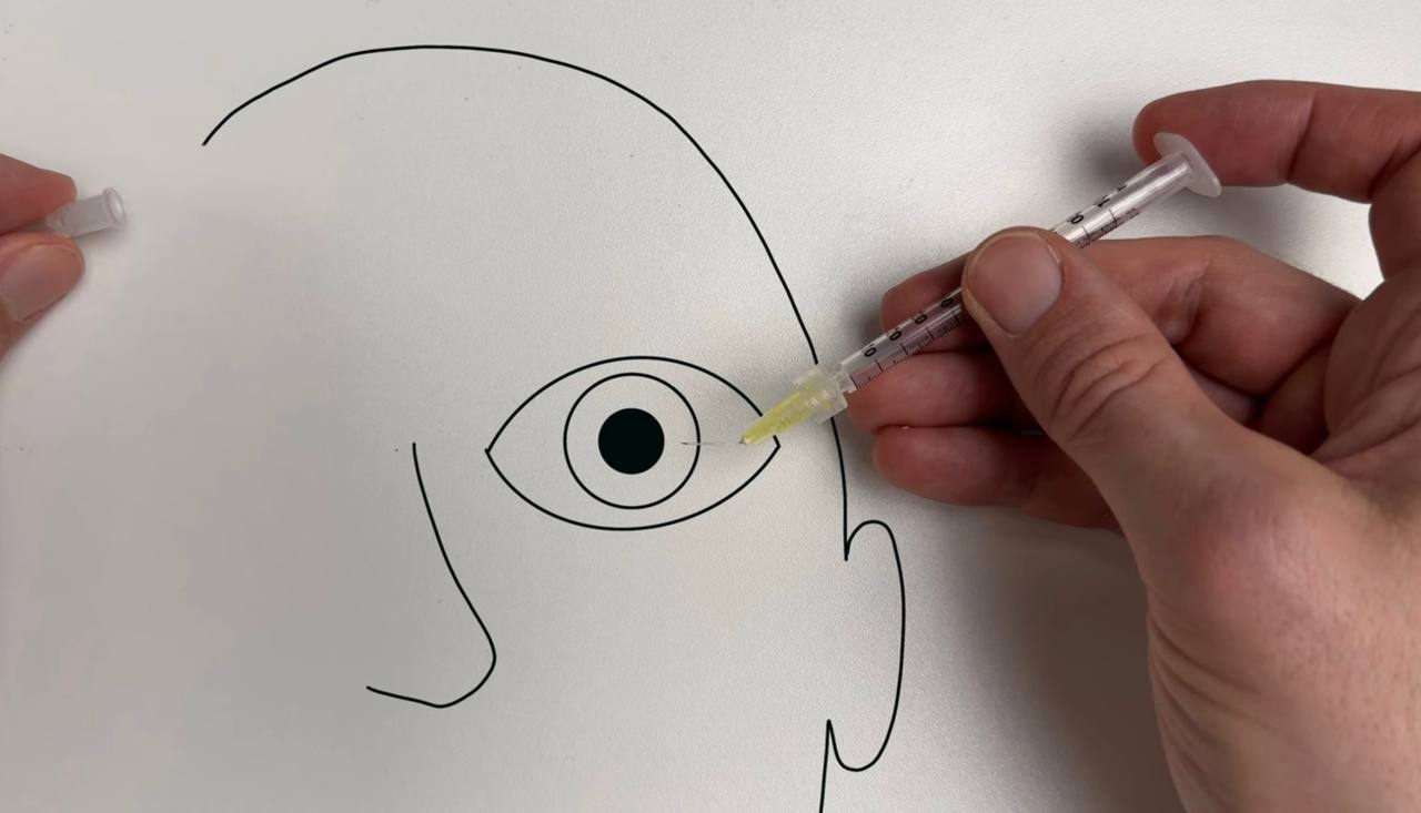 Bent needle being inserted into the eye for anterior chamber paracentesis — ergonomic approach