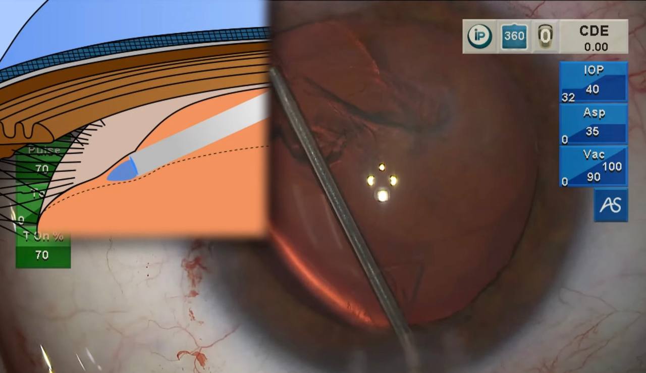 Viscodissection technique during early CTR insertion — cannula separating cortex from capsule with anatomical diagram overlay