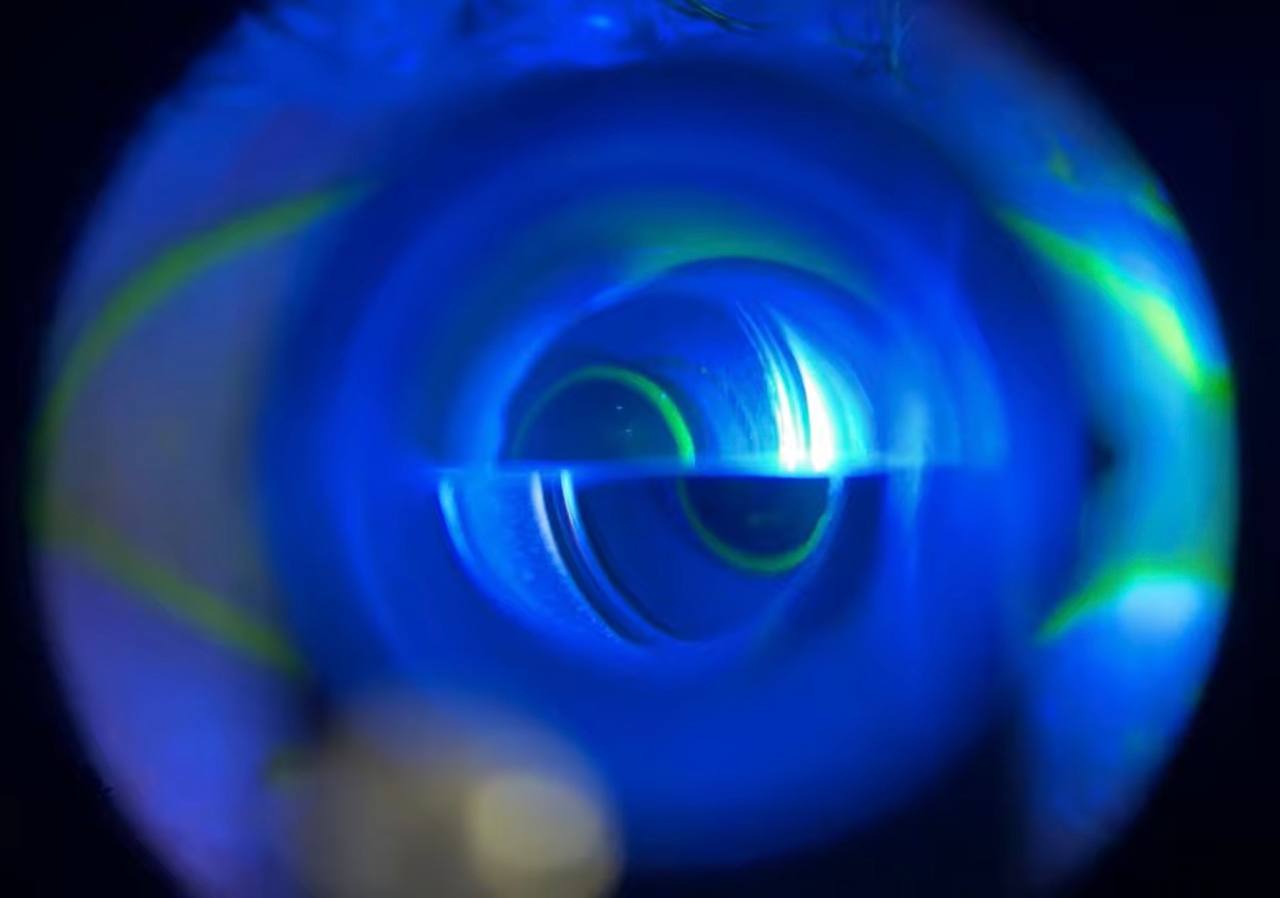 Real slit lamp view of correctly aligned Goldmann tonometry mires — semicircles just touching