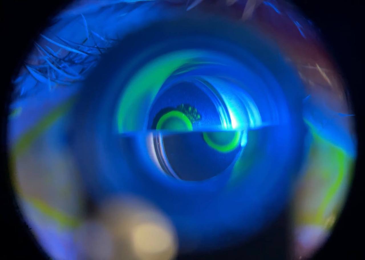 Goldmann tonometry mires when IOP is higher than the dial setting — semicircles overlapping too much