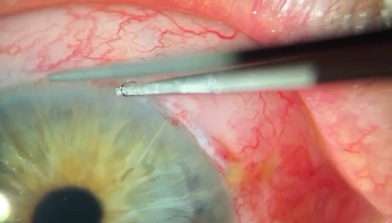 Forceps pulling the 10-0 Nylon ripcord from beneath the conjunctiva