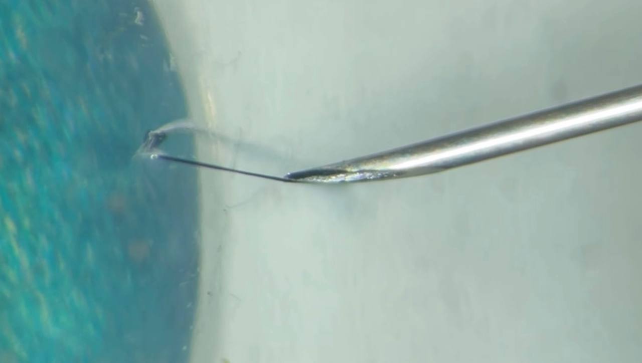 Needle hook catching and lifting the corneal suture from under the epithelium
