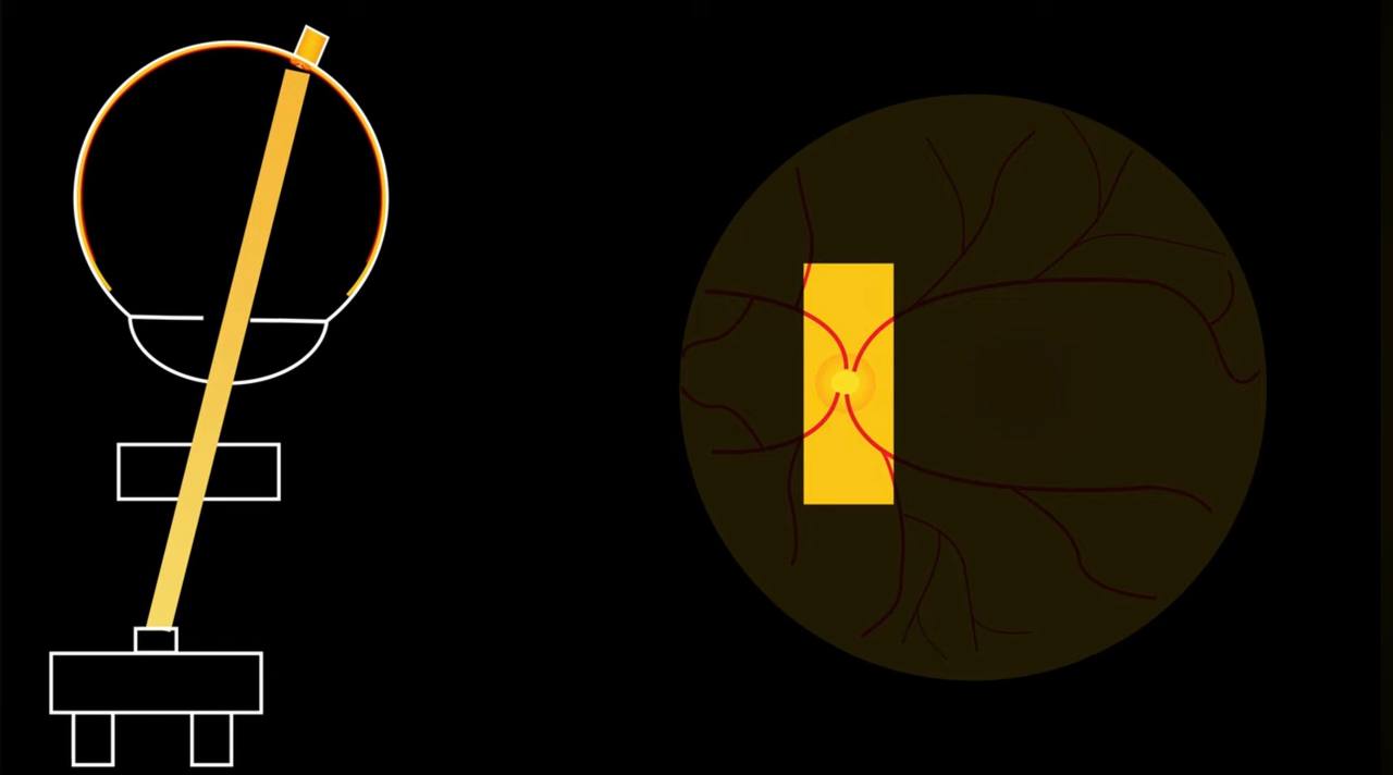 Schematic showing alignment of slit lamp, condensing lens, and eye to visualize the optic nerve, with corresponding fundus view