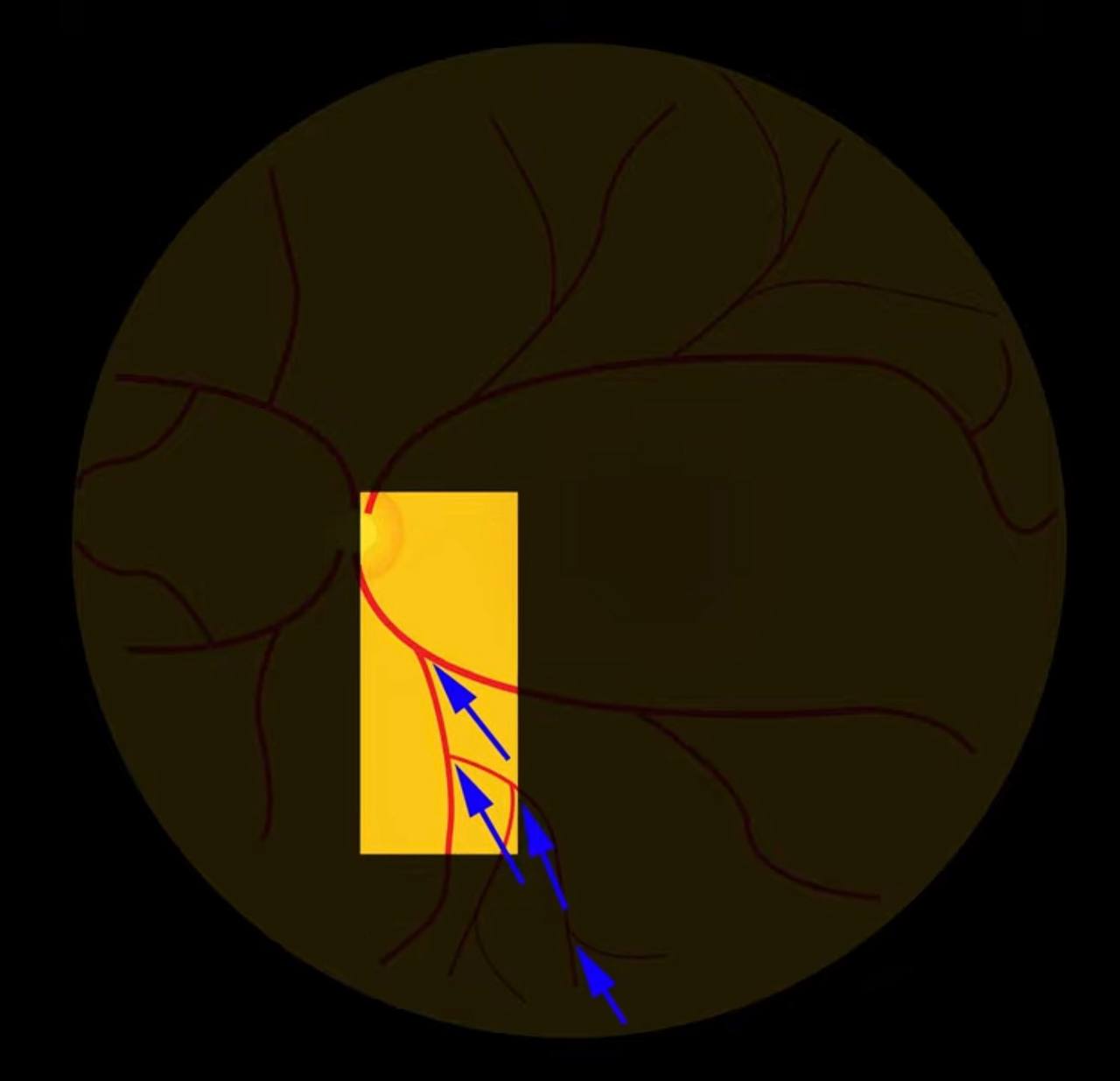 Fundus diagram showing how retinal vessel branching points act as arrows pointing toward the optic nerve